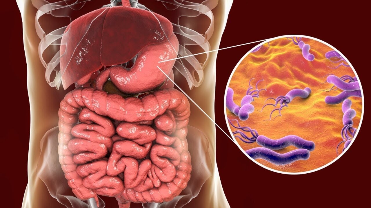 Sveiki! su gydytoju V. Morozovu: kaip atpažinti Helicobacter pylori ir kada ją naikinti?