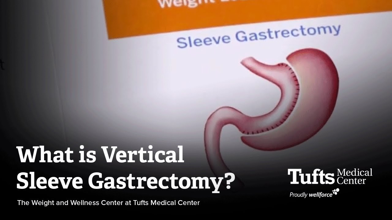 What is Vertical Sleeve Gastrectomy? | Weight and Wellness Center at Tufts Medical Center