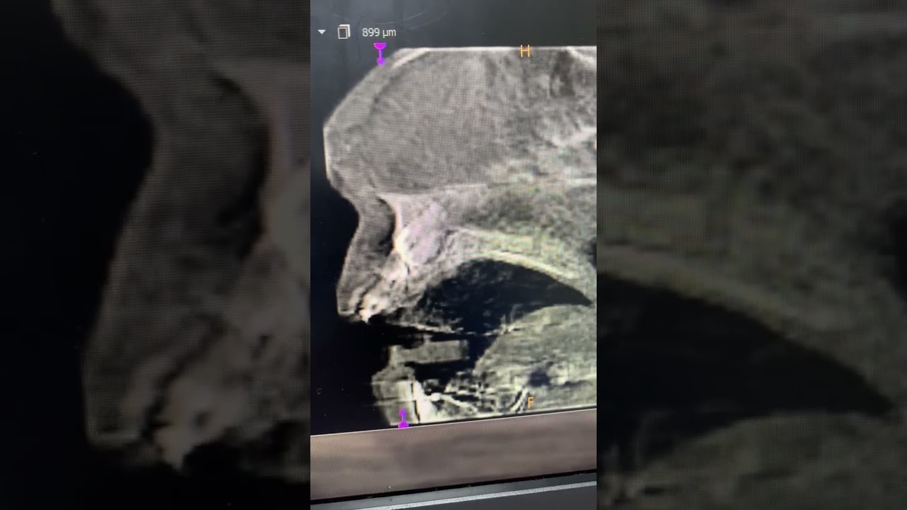 Maxillary Supernumerary Tooth, CBCT sagittal section