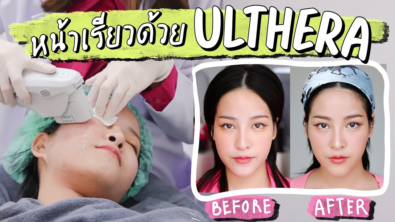 รีวิวทำ ulthera ครั้งแรก หน้าเรียวทันทีจริงไหม!? เจ็บไหม หน้าบวมไหม บอกหมด! | Soundtiss