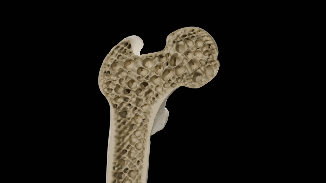 Osteoporosis Awareness