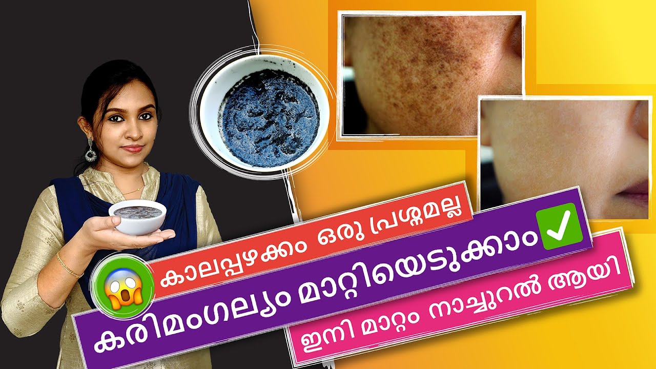 💯പഴക്കമുള്ള കരിമംഗല്യവും മാറ്റം രാത്രിയിൽ ഇത് പുരട്ടിയാൽ മതി🔥|Hyper Pigmentation Remedies|Dark Spots