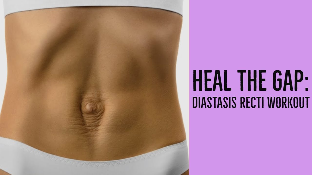 DIASTASIS RECTI WORKOUT | 6 EXERCISES TO HEAL YOUR MOMMY TUMMY GAP