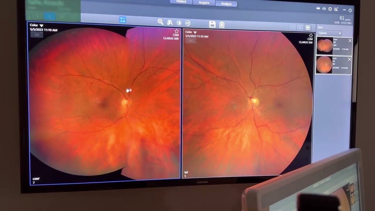 Evaluating The Retina ( the ocular fundus)