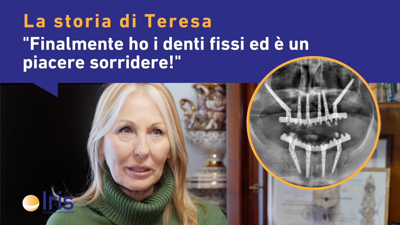 MANCANZA DI OSSO E IMPIANTI ZIGOMATICI: la storia di Teresa di Modena