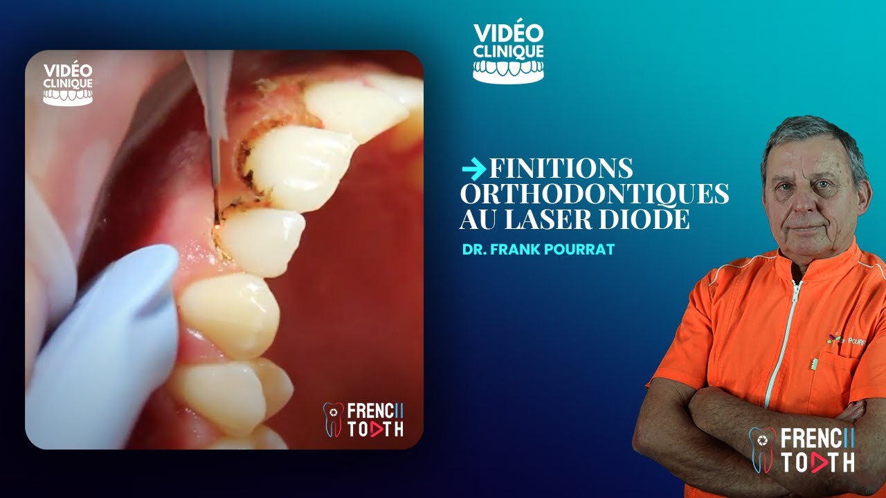 Finitions orthodontiques au laser diode - Dr Pourrat