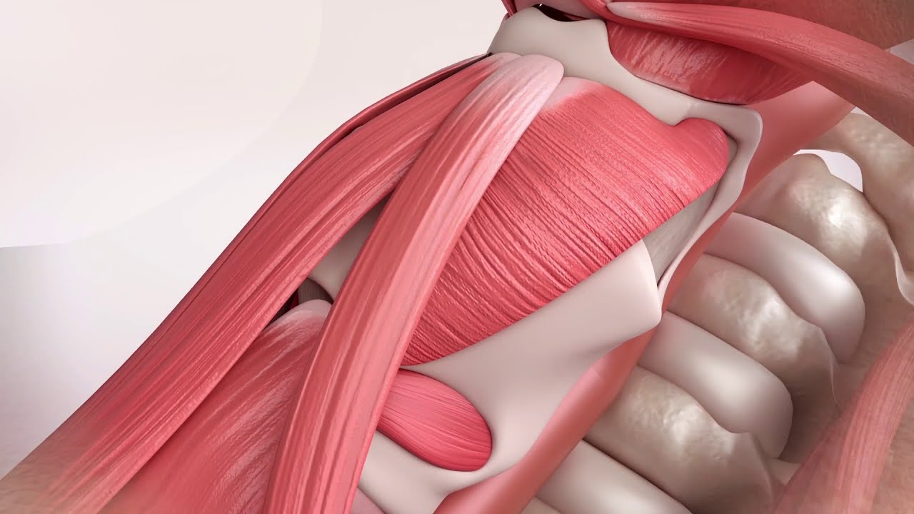 APrevent® VOIS_Standardized type I thyroplasty