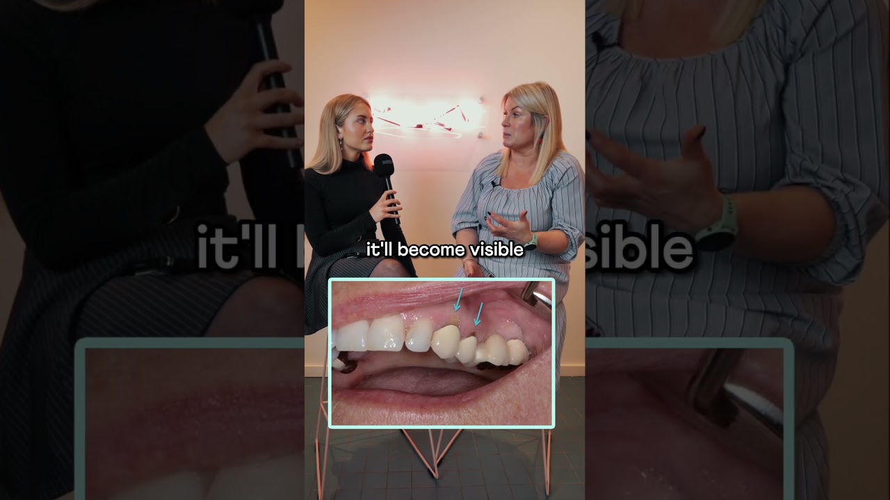 How long does a dental bridge last? 