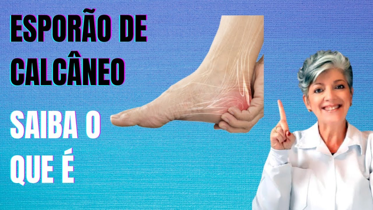 Saiba o Que &eacute; Espor&atilde;o de Calc&acirc;neo