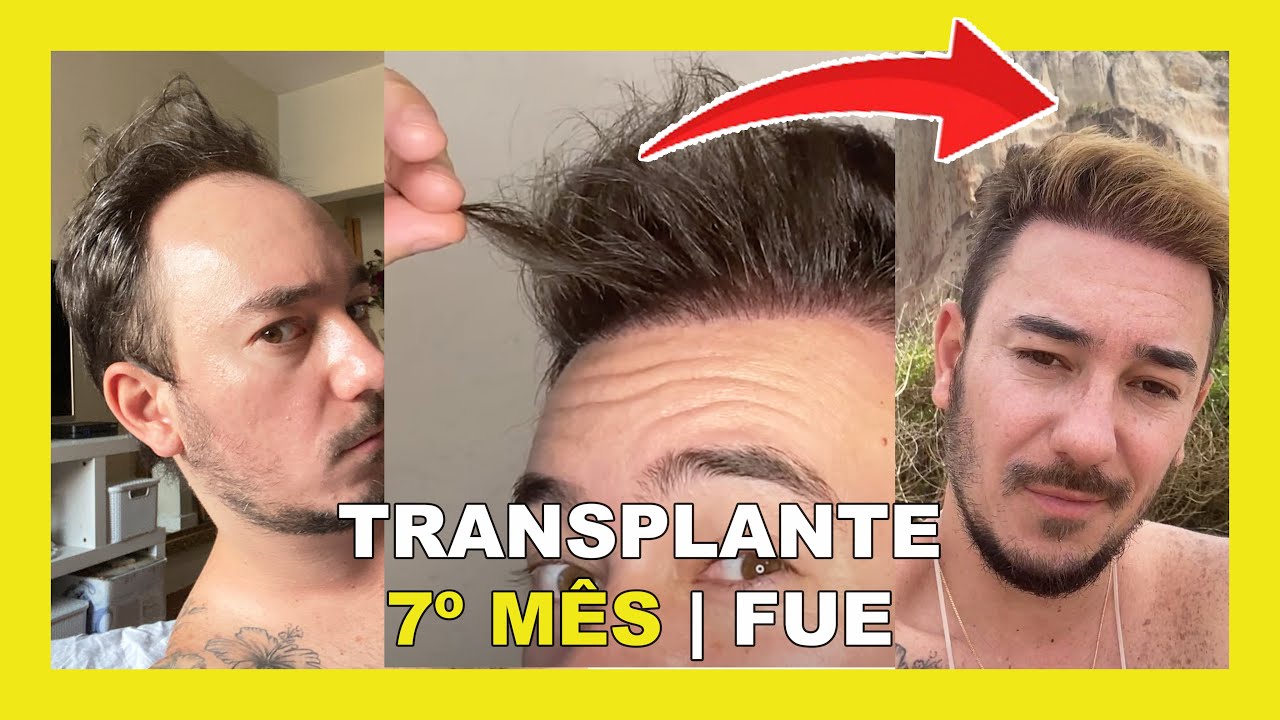 RESULTADO 7 MESES - TRANSPLANTE CAPILAR FUE