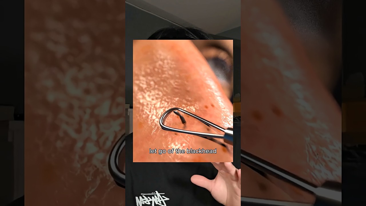 Не давите на кожу инструментами #уходзакожей #рутинауходазакожей #корейскаякрасота #черныеточки #...