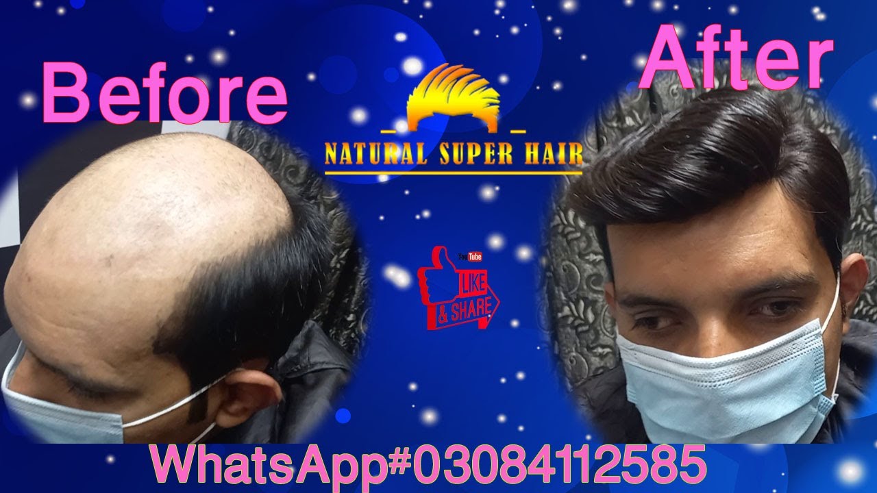 Miraj hair Patch | Skin base hair patch Information about Mirage hair unit