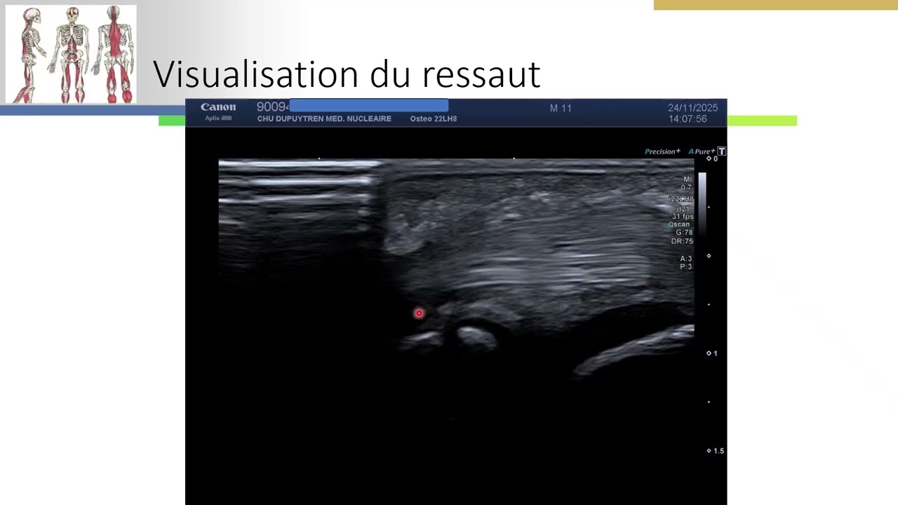 Doigt à ressaut