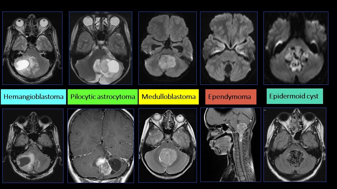 Posterior fossa neoplasms