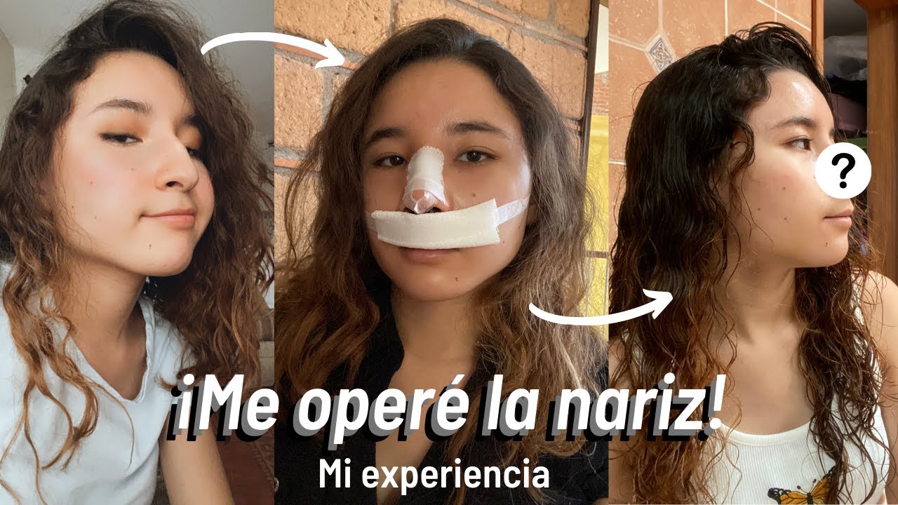 ¡ME OPERÉ LA NARIZ! - Mi experiencia con mi rinoplastia