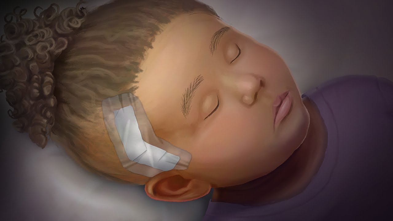 Moyamoya Disease by W. Northam, E. Smith, J. Laird-Gion, J. Perez | OPENPediatrics