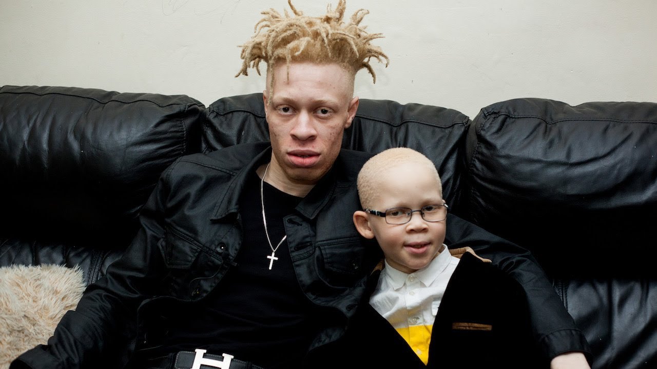 Model With Albinism Inspires Kids With Condition | BORN DIFFERENT