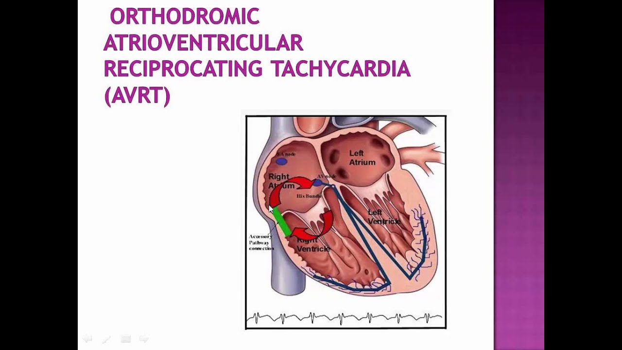 Supraventricular tachycardia