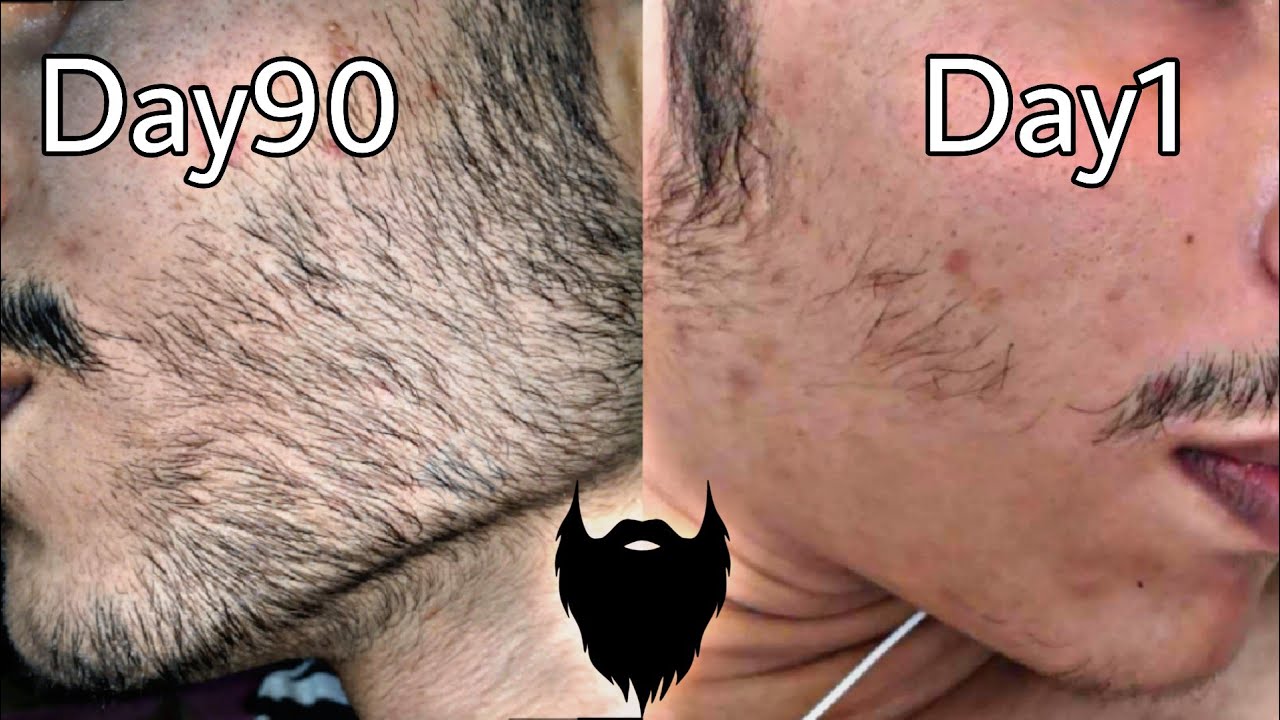 Minoxidil beard journey | 3 months INSANE results!