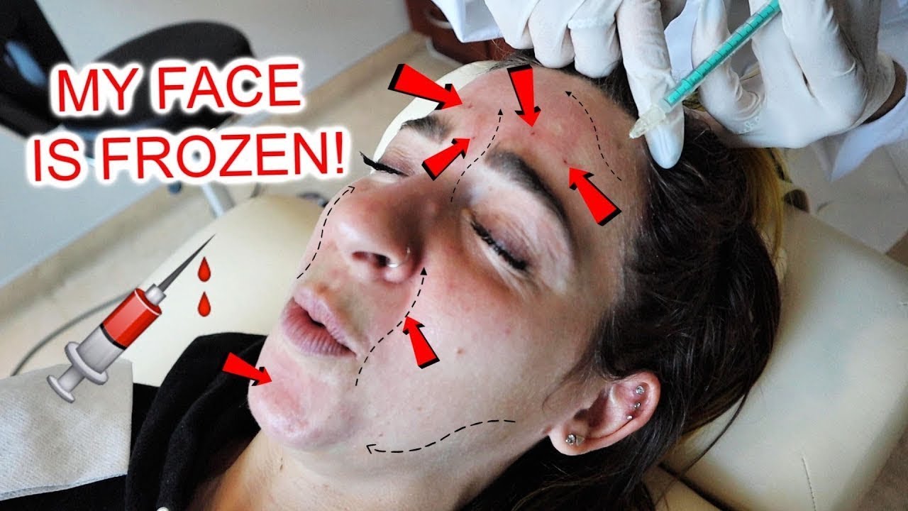 ENTIRE Face Full of BOTOX & FILLER! (I can't move my face...)