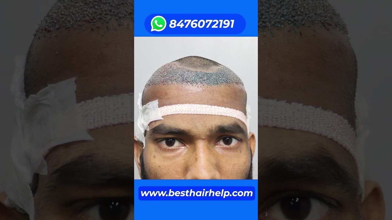 Hair Transplant Cost Of 2000 Grafts 🔥🔥🔥 #hairtransplantcost