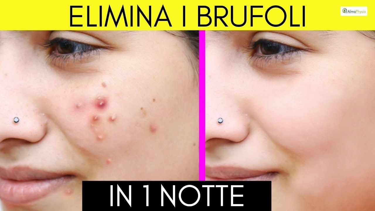 Acne: rimedi naturali per benefici immediati
