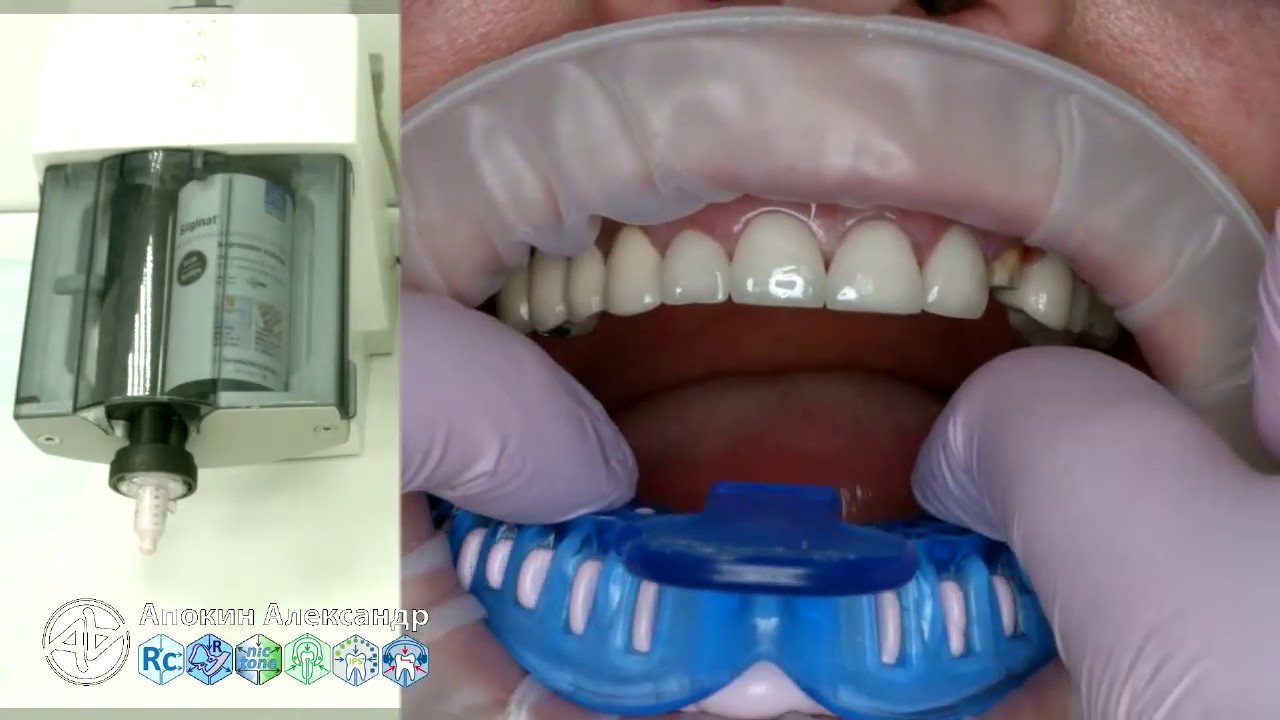 Снятие оттисков Kettenbach Silginat (праямой эфир)