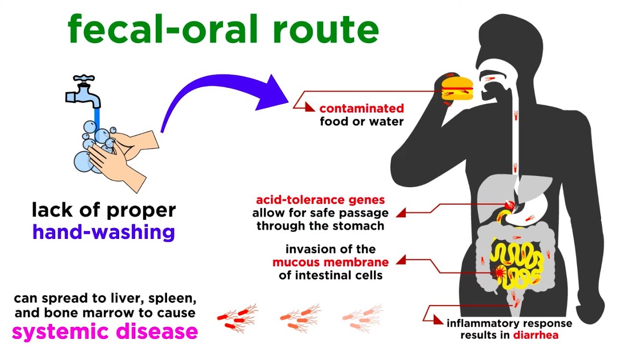 Typhoid Fever: Salmonella typhi