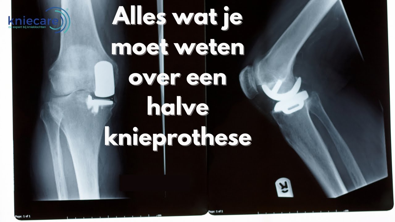 Alles wat je moet weten over een halve knieprothese