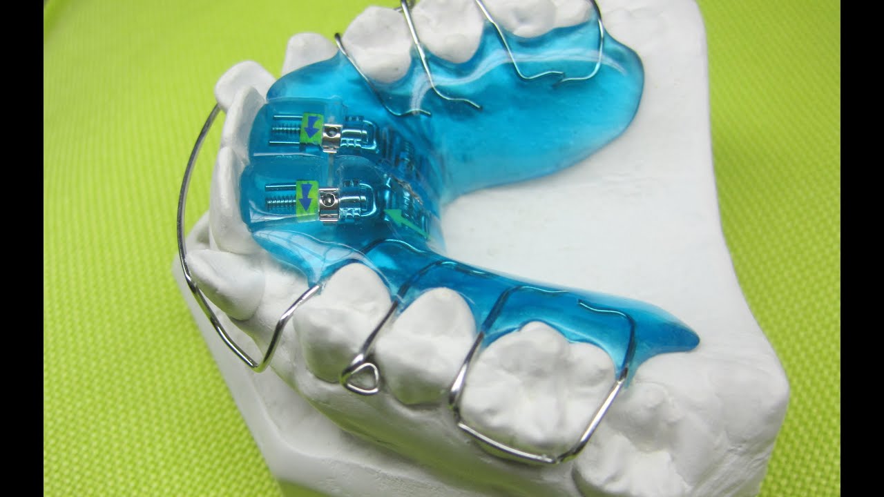 Dehnplatte 2/4 Zahnspange Active Plate Adamsklammer Adams clasp Kieferorthopädie Orthodontics
