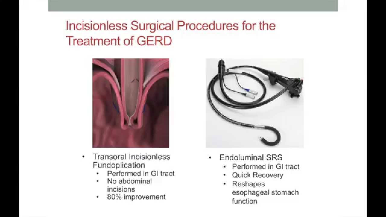 Surgical Treatment of GERD