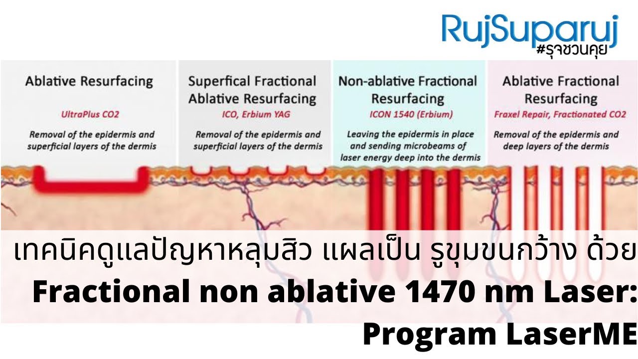ดูแลปัญหาหลุมสิว แผลเป็น รูขุมขนกว้าง ด้วย Fractional non ablative 1470 nm Laser: Program LaserME
