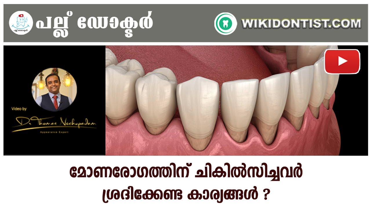 മോണരോഗത്തിന് ചികിൽസിച്ചവർ  ശ്രദിക്കേണ്ട കാര്യങ്ങൾ ? / Gum Disease / Video by Dr. Thomas Nechupadam