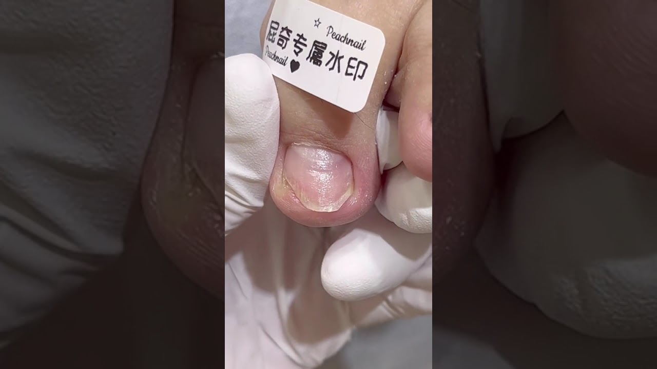 Pedicure#Paronychia#Ingrown nails#Type A adjustment#Chengdu#Chenghua District