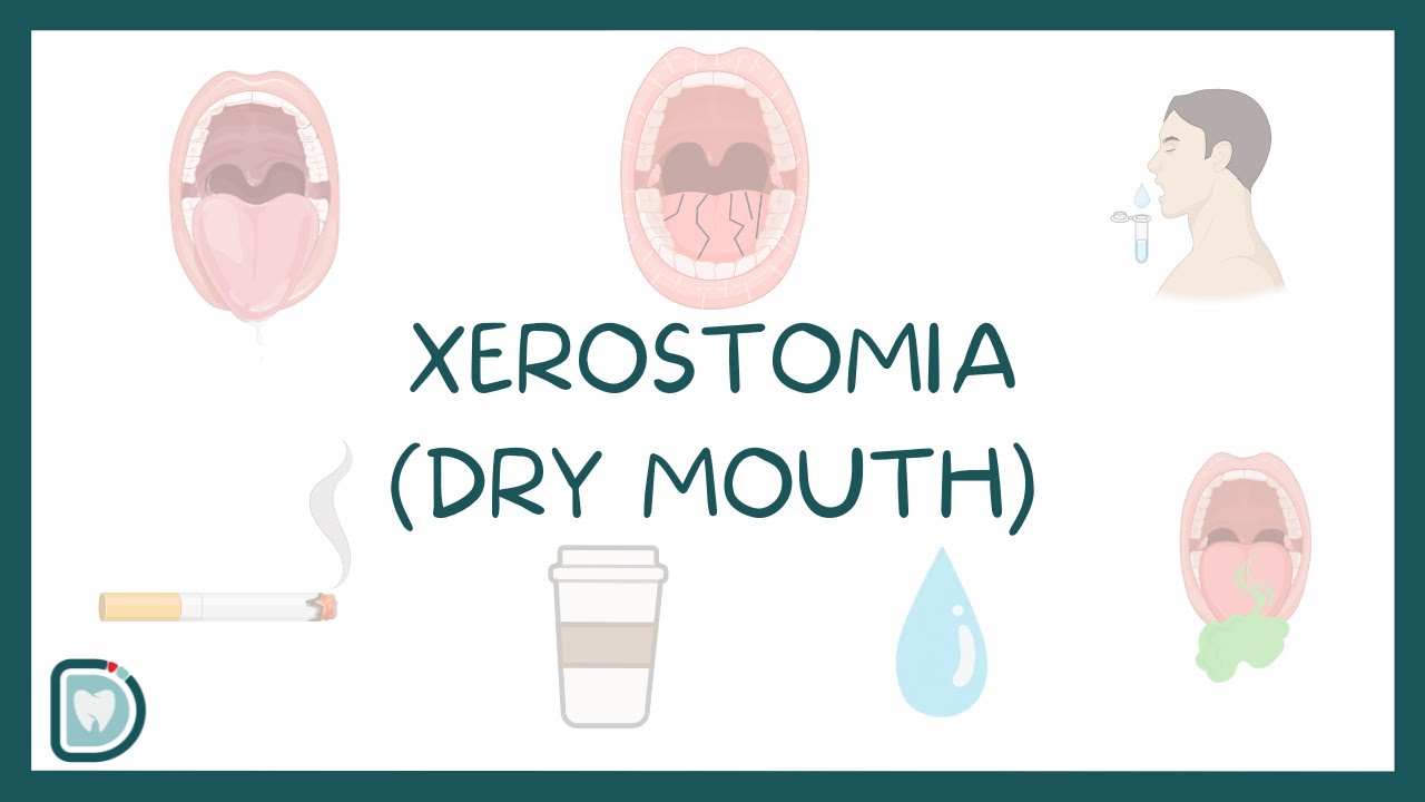 Dry Mouth or Xerostomia: Causes, Symptoms, Diagnosis, and Treatment