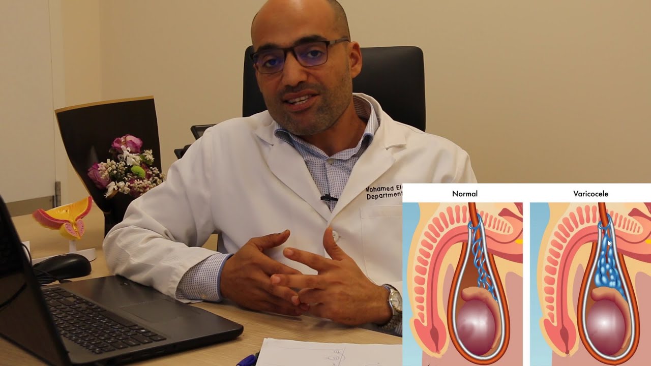 Varicocele: A Simple Lecture for All Patients and All Questions Answered in 10 Minutes