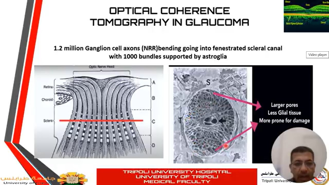 OPTICAL COHERENCE TOMOGRAPHY (OCT) IN GLAUCOMA  2