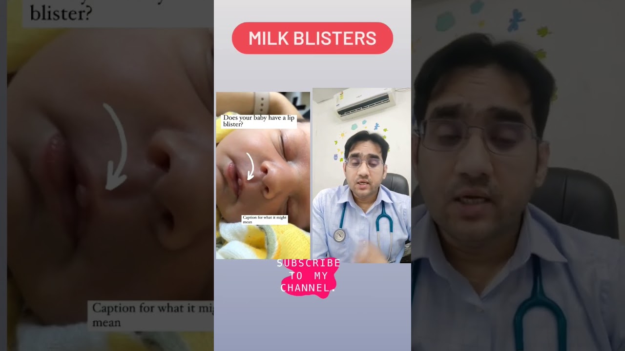 MILK BLISTERS in Baby | Dr Md Noor Alam Khan| #shorts #healthychild #healthyChildShorts