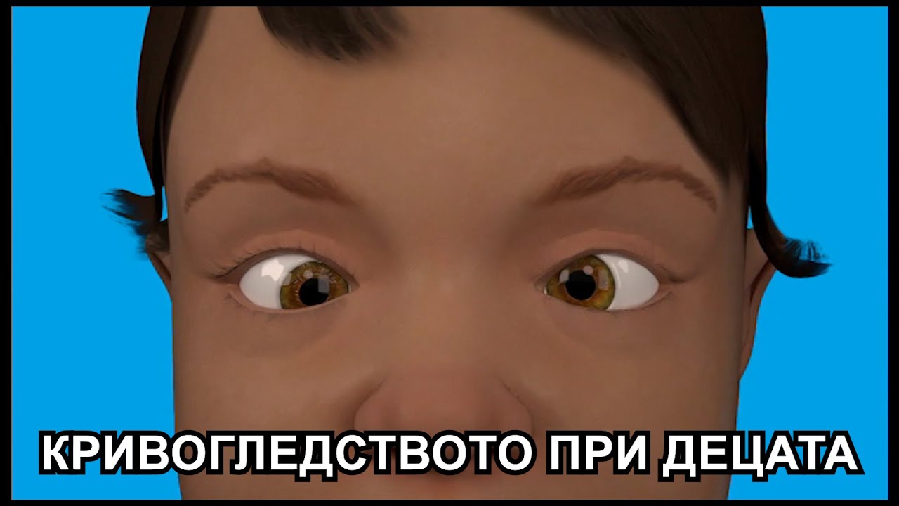 Кривогледство в детска възраст