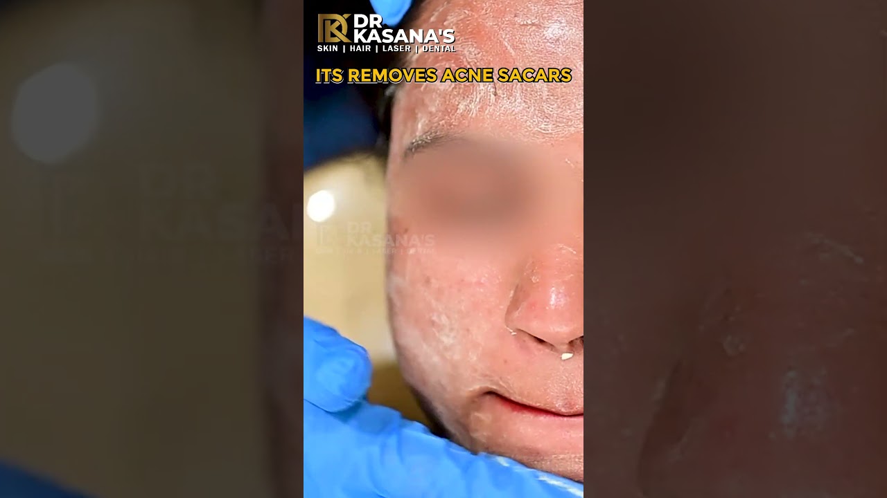 yellow peel treatment before and after 