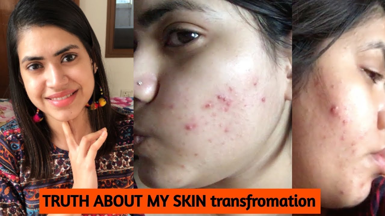 How I cleared my SKIN from ACNE & DARK SPOTS