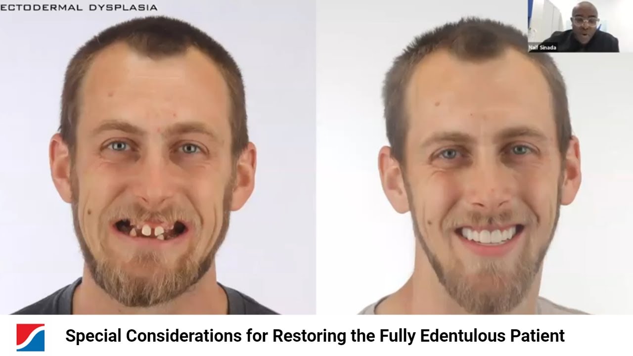 Special Considerations for Restoring the Fully Edentulous Patient