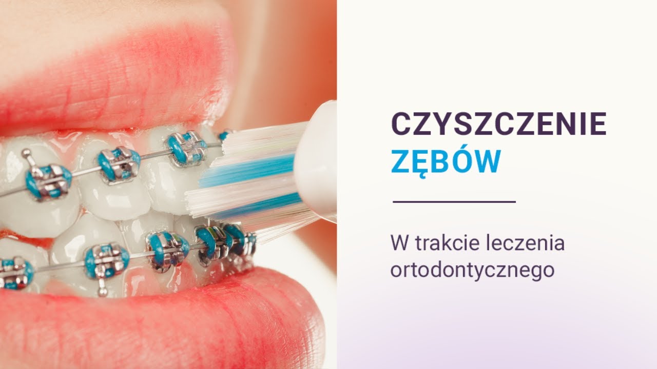 Jak czyścić zęby z aparatem ortodontycznym? | Ortodent Rzeszów