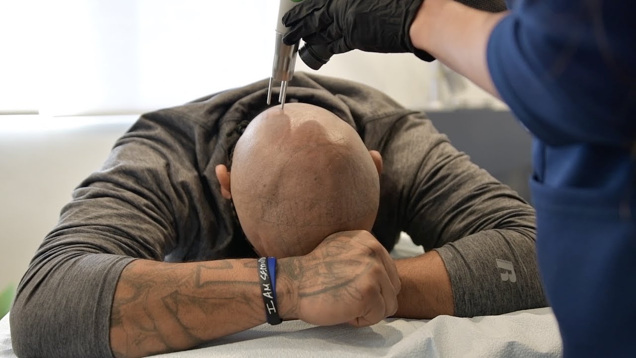 Laser Tattoo Removal on Rigo's Head - Evolve Tattoo Rremoval - San Diego, CA