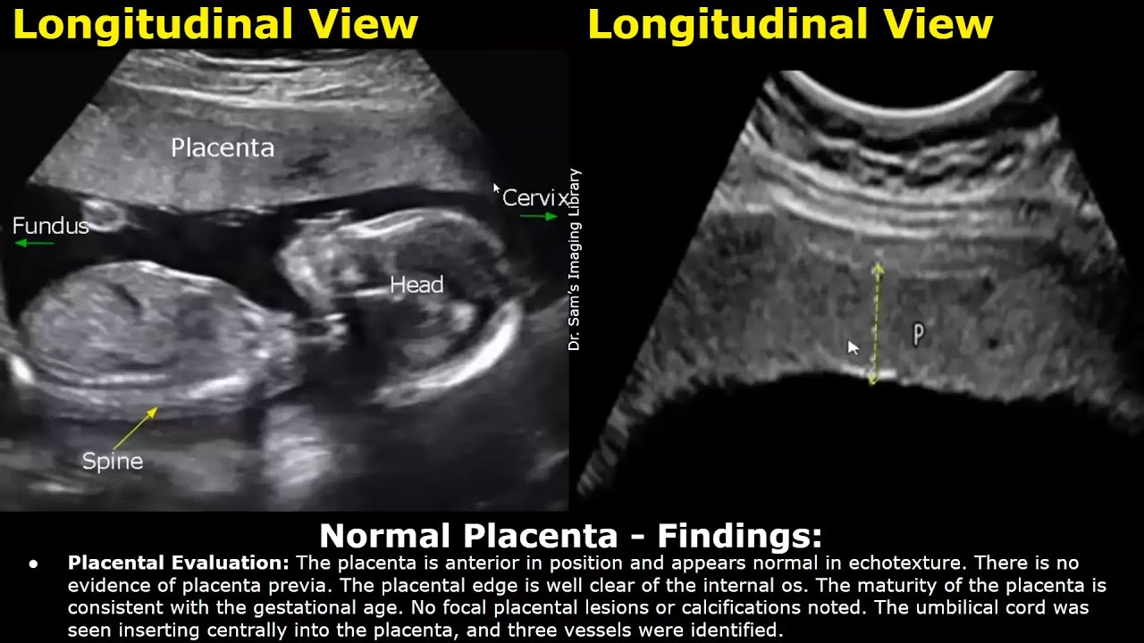 Placenta Ultrasound Reporting | How To Write Pregnancy USG Reports | Pathologies & Positions Scans