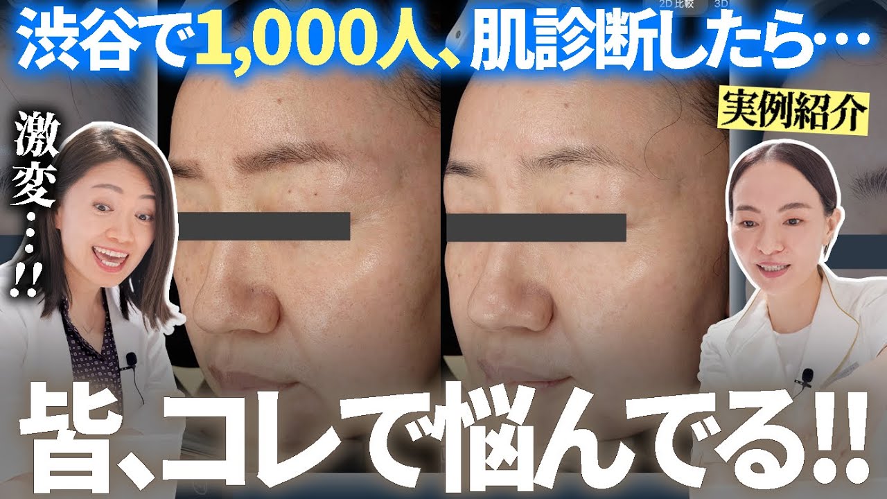 渋谷で年間1,000人肌診断「一番多い肌悩み」TOP.3実例発表