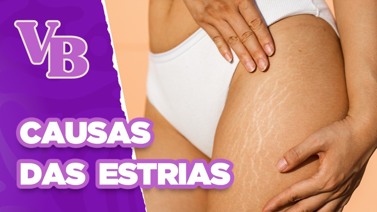 Tudo sobre ESTRIAS, suas causas, tipos e tratamentos - Você Bonita (14/02/2025)
