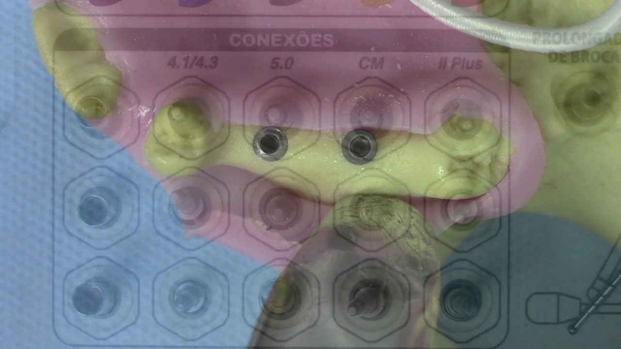 Gota #9 - SEQUÊNCIA DE INSTALAÇÃO DE IMPLANTES HEXÁGONO EXTERNO E CONE-MORSE
