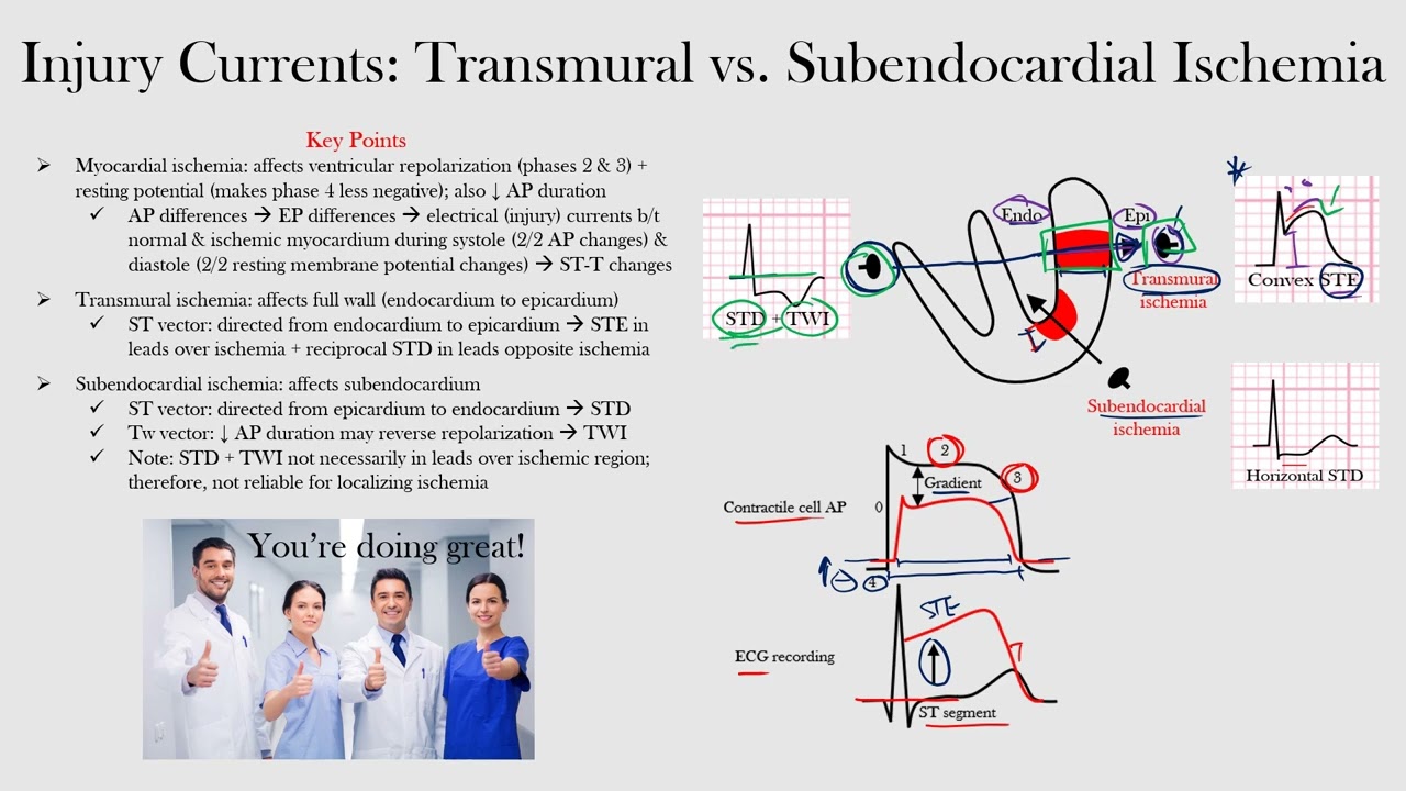 Transmural vs. Subendocardial Ischemia