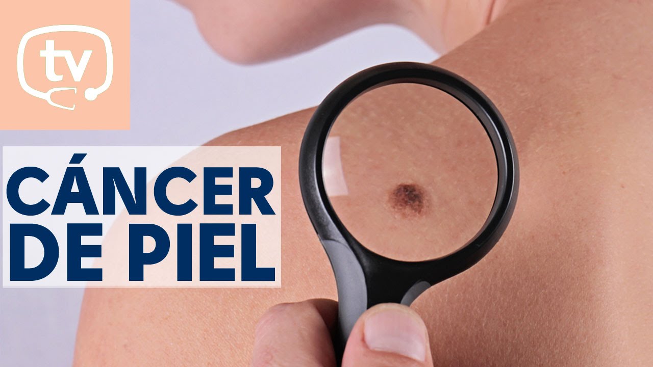 Todo lo que debes saber sobre el cáncer de piel